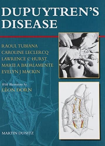 Cover image for Dupuytren's disease